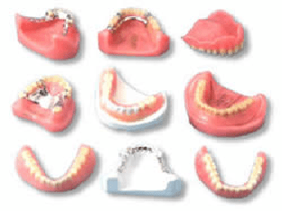 Какие бывают зубные протезы: виды и как выбрать