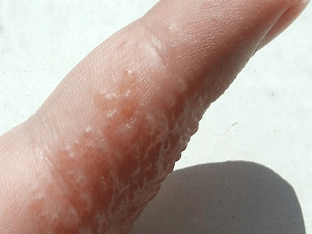 Почему появились водянистые пузырьки на коже рук