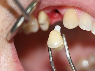 Современные зубные протезы, какие лучше установить