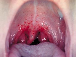 Как проявляется гонорея при поражении полости рта и горла