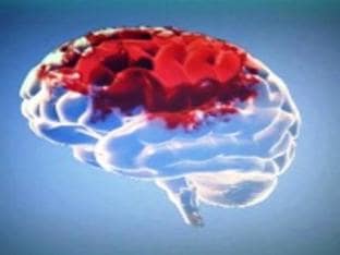 Инфаркт головного мозга: что это такое, какие симптомы и последствия