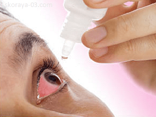 Какие глазные капли помогают при аллергии