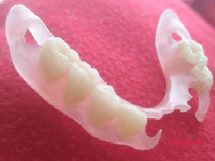 Что лучше зубные имплантанты или протезирование зубов