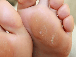 Натоптыши на ступнях: причины и лечение
