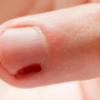 Заусенцы на пальцах рук: чем лечить?