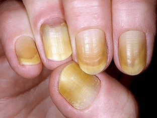 Желтые ногти? Причины могут быть серьезными
