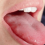 Жжение языка: причины и лечение