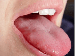 Жжение языка: причины и лечение