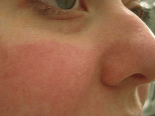 Гиперемия кожи: что это такое и как лечить заболевание