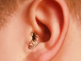 Грибок в ушах: как лечить? Почему появляется