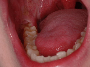 Почему стоматологи не ставят имплантант зуба мудрости, а удаляют его