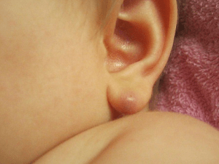 Почему появился шарик в мочке уха