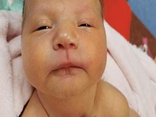 Чем лечить болячки в носу у ребенка