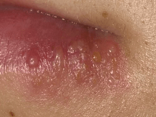 Герпес на губах: быстрое лечение в домашних условиях