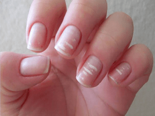 Причина белых пятен на ногтях: способы избавления