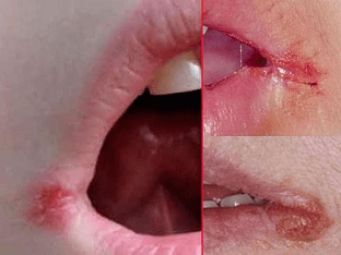Заеды в уголках рта – причины трещин, как лечить?