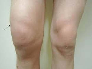 Лечение коленного сустава и способы снятия боли