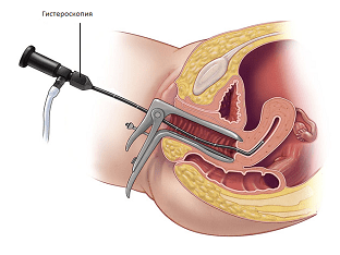 В каких случаях назначают операцию гистероскопия матки