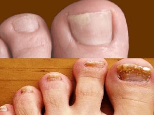 Как вылечить грибок ногтей на ногах