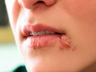 Как выглядит герпес на губах, и какие способы его лечения