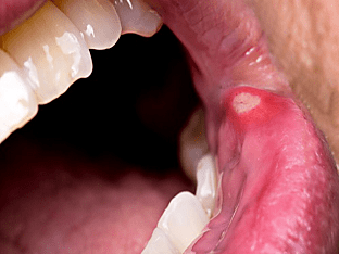 Как избавиться от стоматита во рту быстро и навсегда
