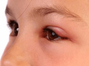 Глаза опухли и чешутся: причины и лечение