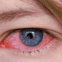 Кератит глаза: симптомы и лечение