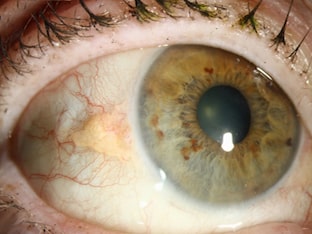 Пятно на белке глаза — что означает желтое, красное, серое или темные пятна на белке глаза