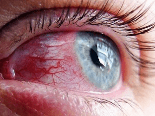 Почему лопаются сосуды в глазах? Причины и лечение
