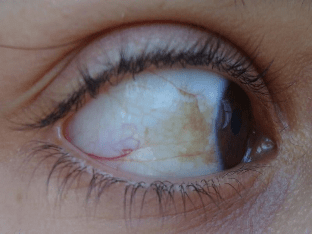 Желтые глаза у человека - причины, симптомы и лечение