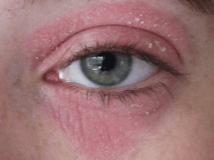 Покраснение вокруг глаз - причины, лечение