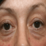 Грыжи под глазами: причины появления, методы удаления