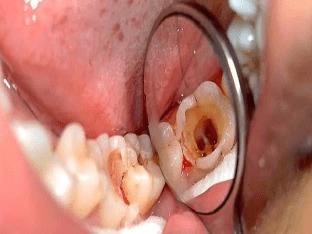 Суть лечения корневых каналов зубов. Больно ли это