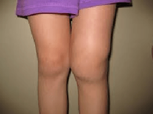 Как лечить артрит коленного сустава у детей