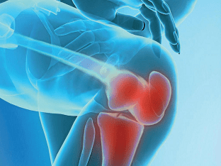 Что такое артрит коленного сустава: причины развития и лечение