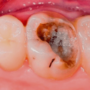 Глубокий кариес: лечение и профилактика заболевания