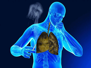 Хронический бронхит курильщика: лечение и симптомы
