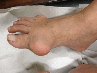 Как лечить подагру на ногах: эффективные способы
