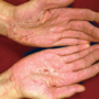 От чего образуется профессиональная экзема, как лечить?