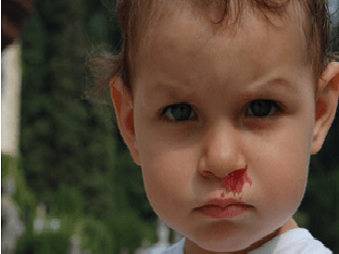 У ребенка идет кровь из носа: причины