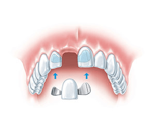 Временные протезы зубов, как способ избавления от беззубости