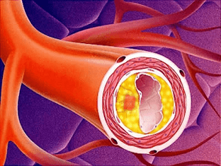 Атеросклероз аорты сердца: что это такое и как лечить