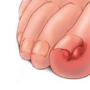 Что делать, если врастает ноготь?