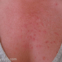 Что означают красные сыпь на груди?