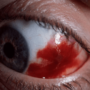 Почему лопнул сосуд в глазу и что нужно делать в этом случае?
