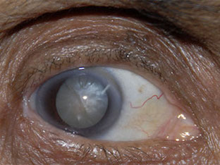 Какие первые признаки катаракты глаз