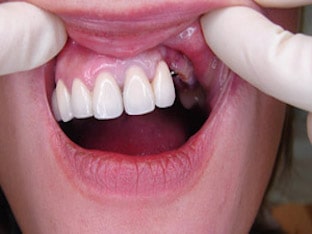 Какие технологии применяются для протезирования передних зубов
