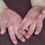 Облазит кожа рук у ребенка — причины и лечение?