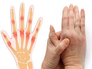Почему болят суставы пальцев рук