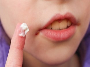 Почему у ребенка появляются заеды в уголках рта и как вылечить недуг